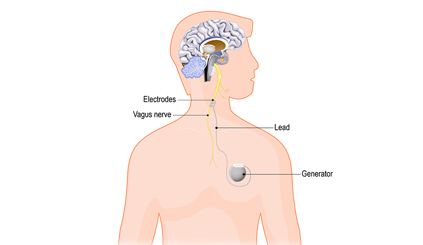 A diagram showing the placement of the vagus nerve stimulation (VNS) device.